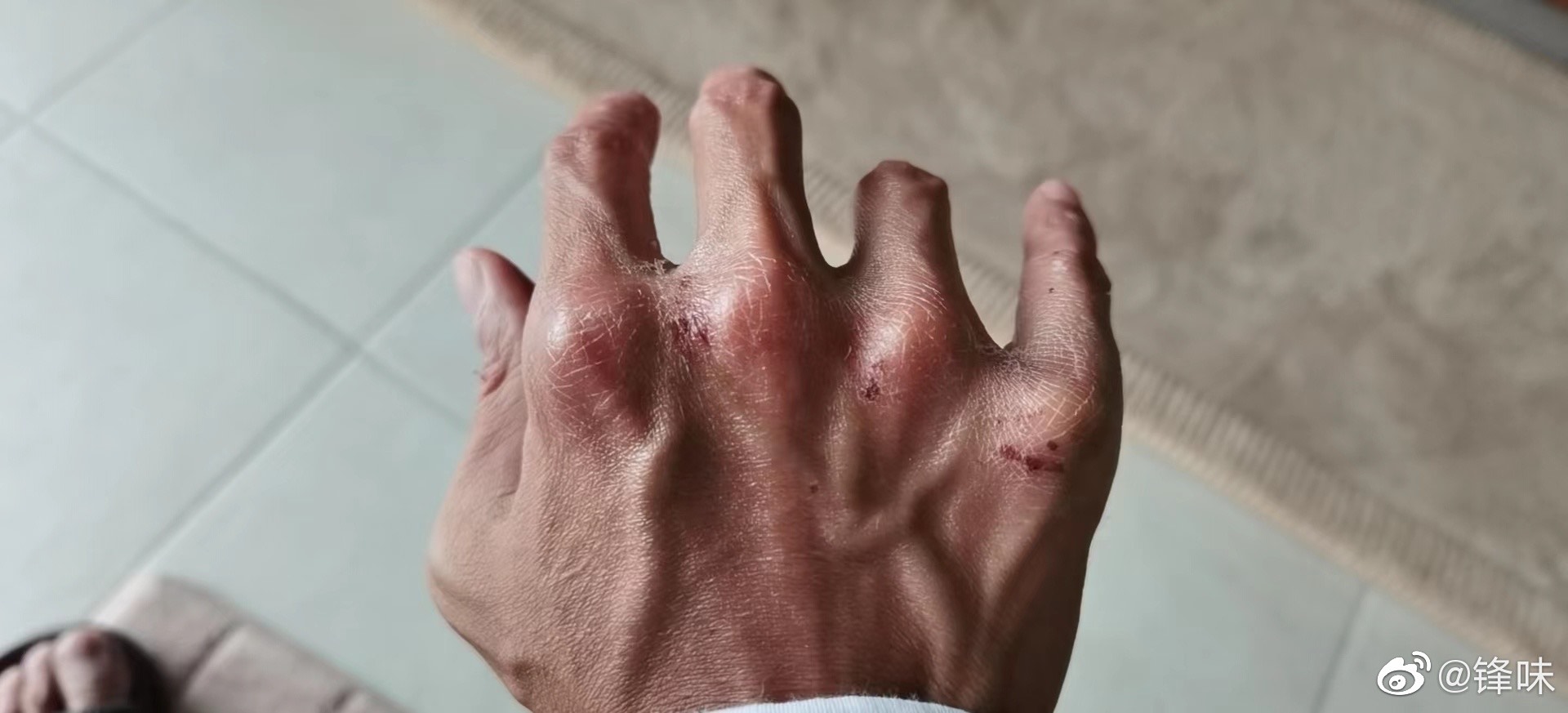 謝霆鋒在微博分享了一張自己的右手照片，滿是傷痕。（圖／翻攝自謝霆鋒微博）