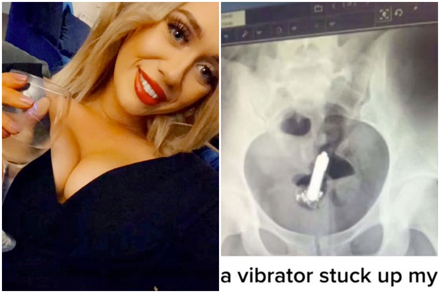 英國一名辣媽不小心將「姊夫」塞入自己的屁股裡，最後只能動手術取出。（翻攝自TikTok）