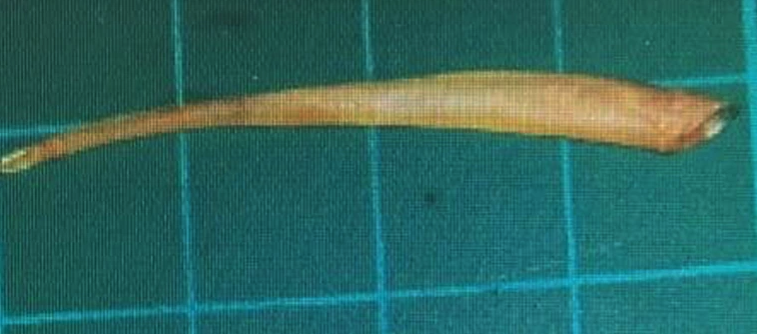 57歲江女吞下4公分魚刺卡在近肛門處,休克併發橫紋肌溶解,最終面臨終生洗腎。(阮綜合醫院提供)