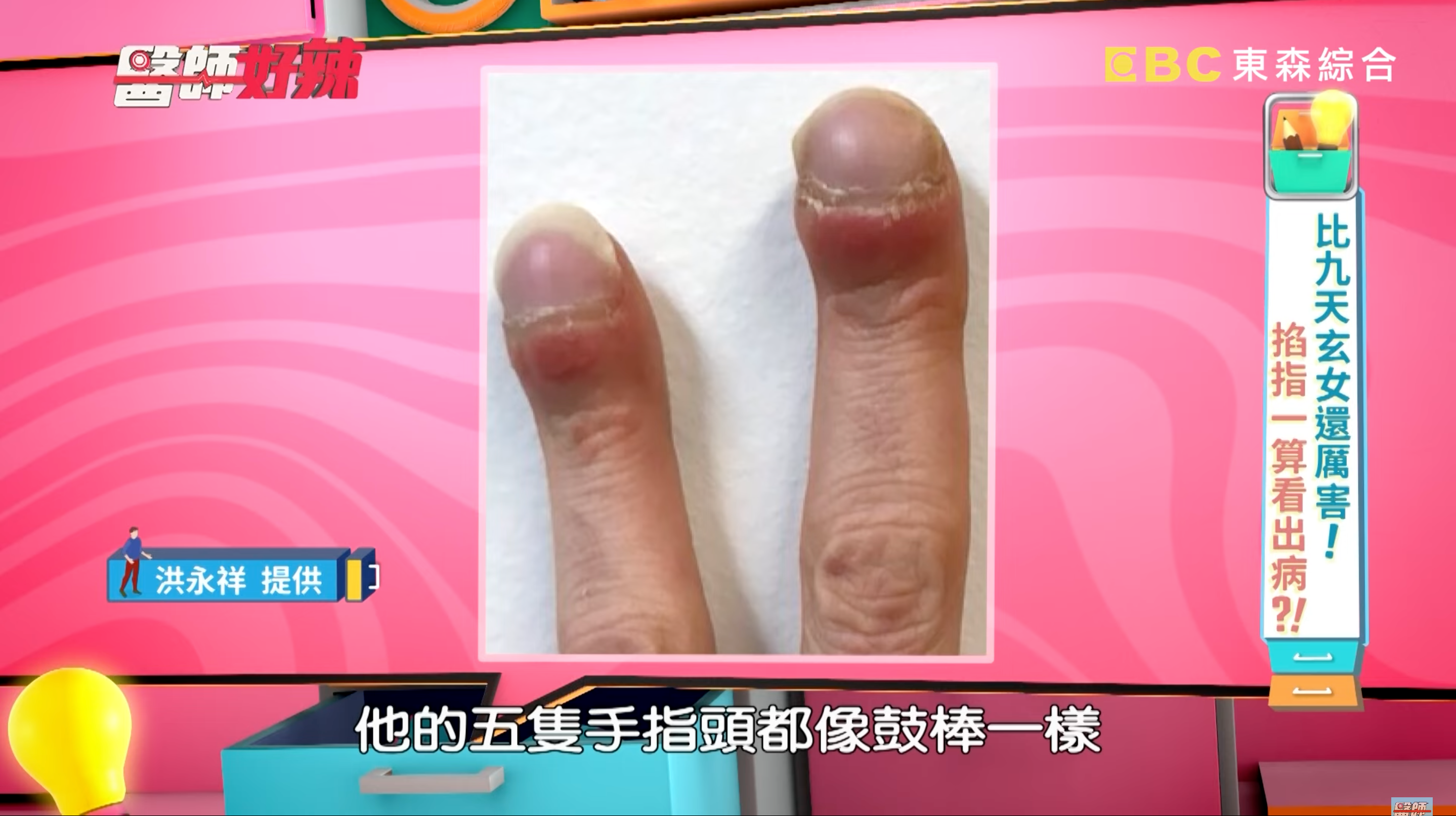 一名婦人出現「杵狀指」症狀,一查竟然是肺腺癌。(翻攝自醫師好辣YouTube)