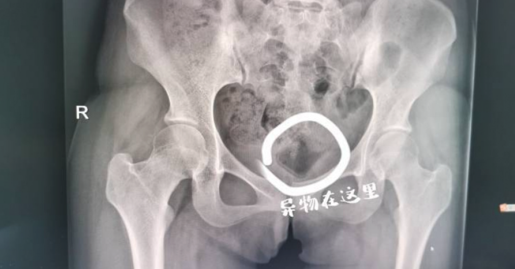 中國杭州一名女大生和男友為了刺激，竟將異物塞進下體，卻不慎卡住，一個月後發臭才求診。（翻攝錢江晚報）