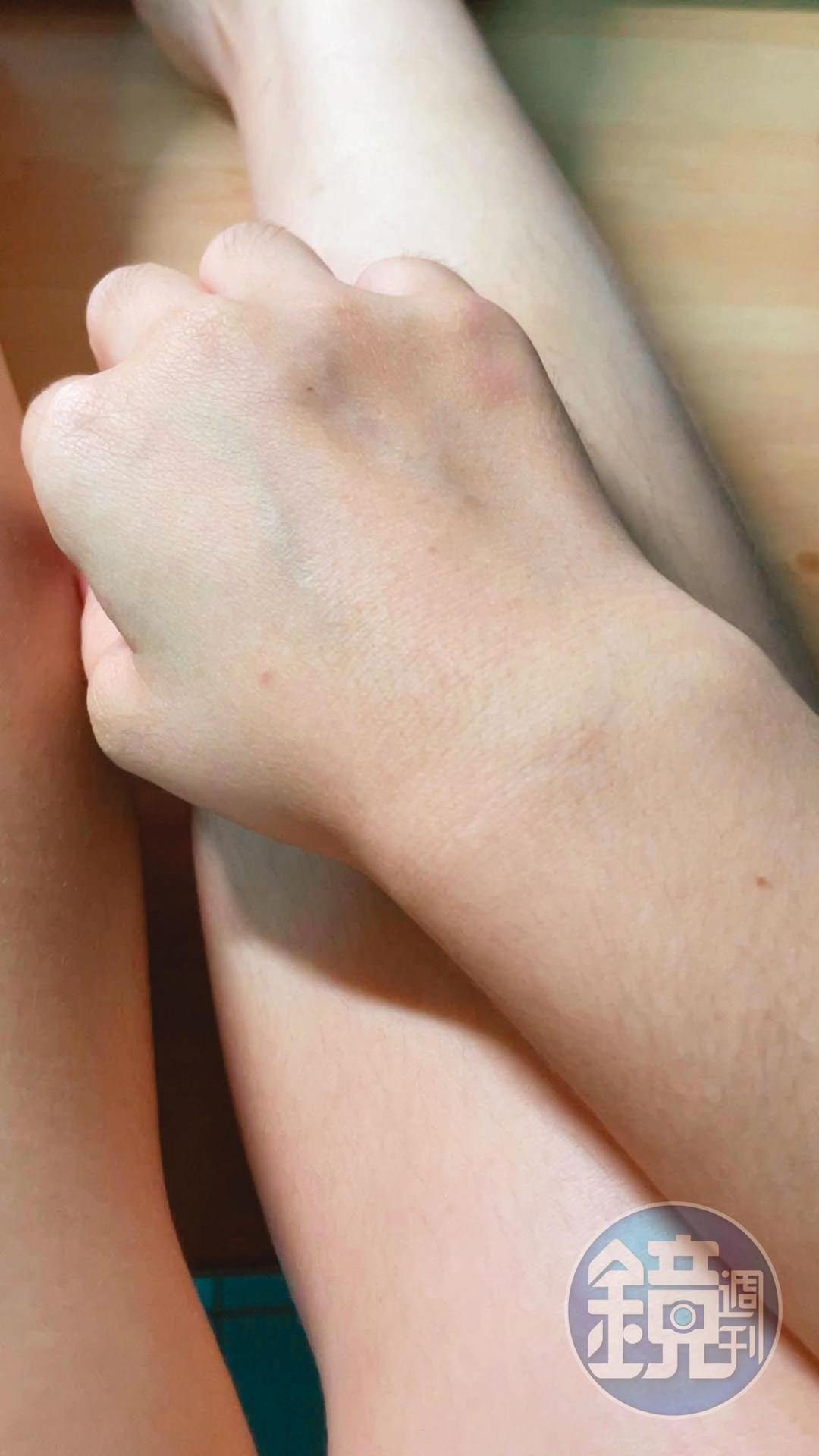 A女因陳嘉義想搶她懷裡的包包，被拉扯在地上拖行，四肢多處瘀傷。（讀者提供）