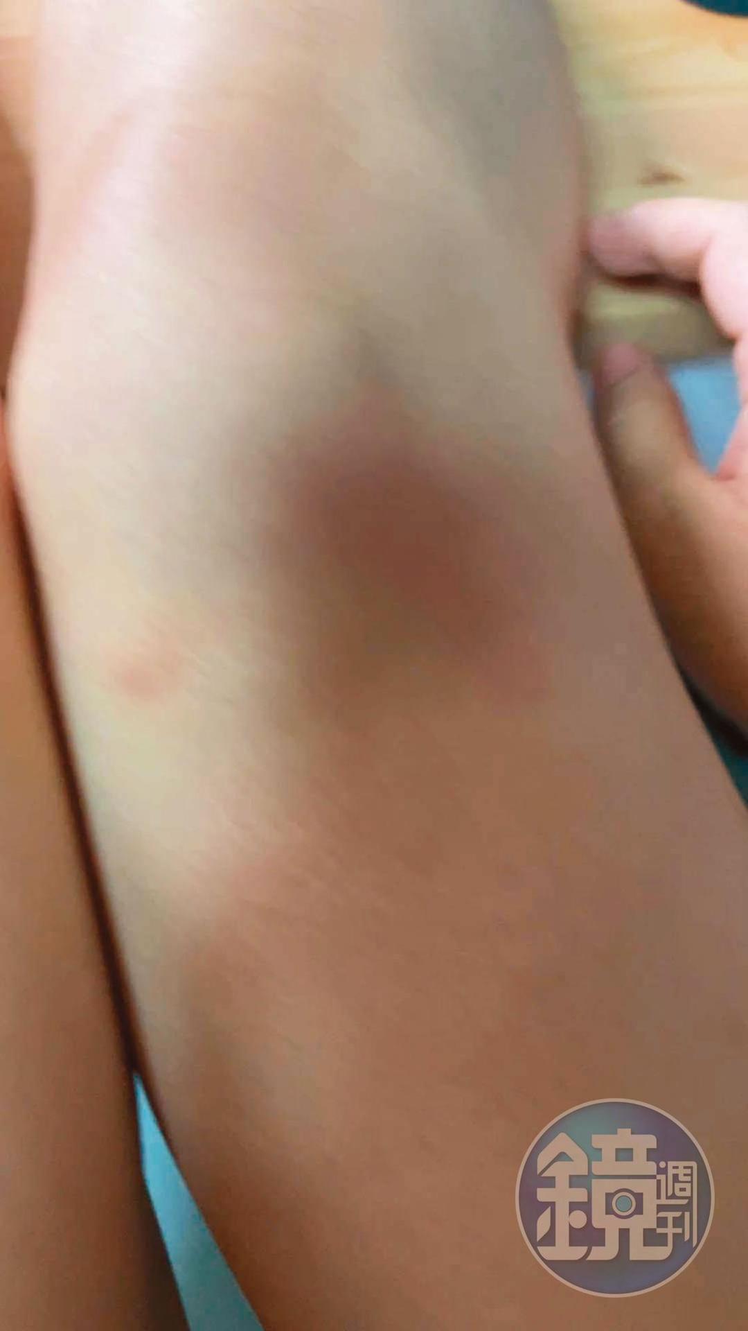 A女秀出大腿大片瘀傷，她因害怕陳嘉義報復，而不敢報警。（讀者提供）