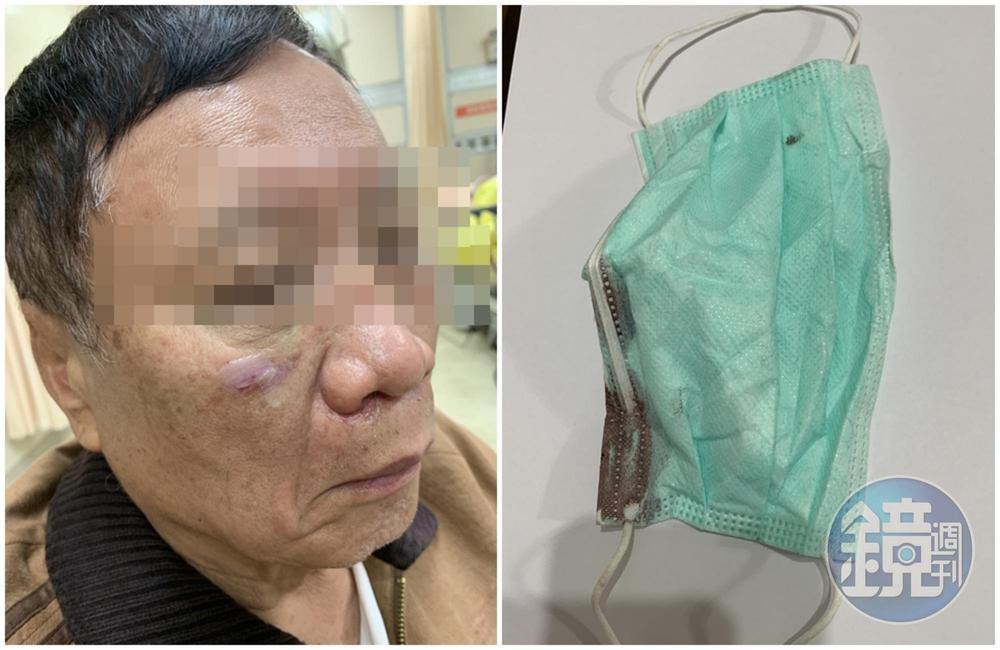 楊姓董座當時被強押拘禁毆打,臉部多處明顯傷勢,獲釋時口罩還留有血跡。(讀者提供)