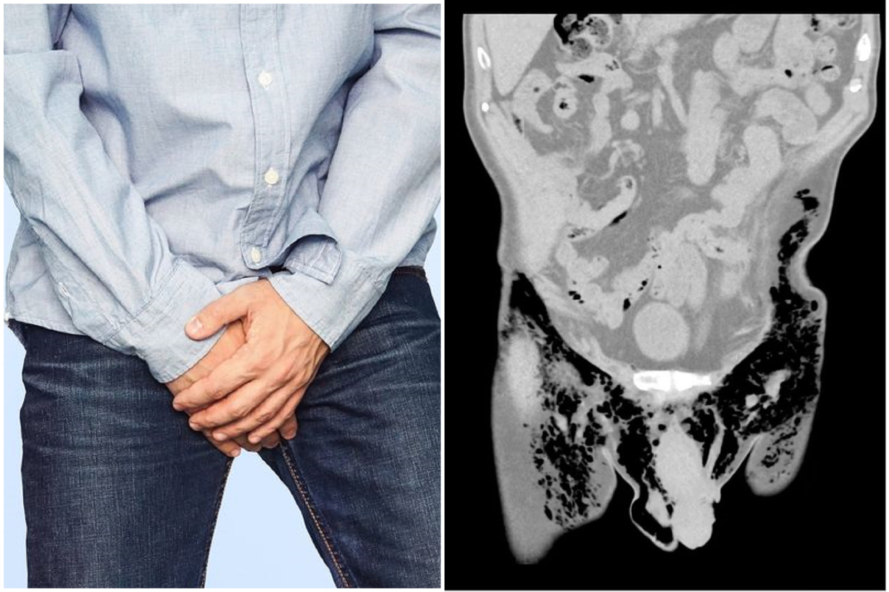 他生殖器真的會叫「啊嘶」！醫認證全球首例，結局超悲劇「睪丸全被切」。（翻自《美國病例報告》）