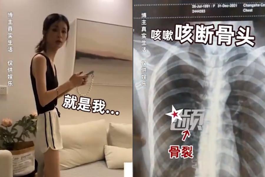 湖南一名女子身高175公分體重僅46公斤,一度因為咳嗽咳到肋骨斷掉。(翻攝自微博)