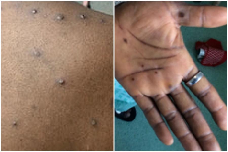 疾管署今天公布第2例猴痘境外移入個案。(示意圖,翻攝自美國CDC網站)