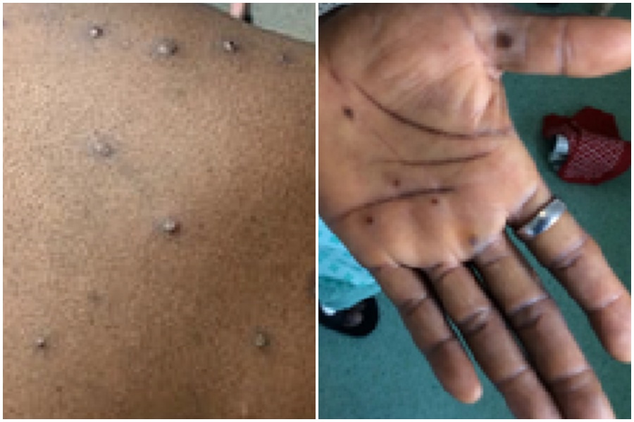 疾管署今天公布第2例猴痘境外移入個案。（示意圖，翻攝自美國CDC網站）