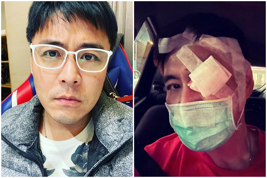 劉至翰昨（12日）他突然在社群網站PO出紗布包臉的照片（右圖），嚇壞不少網友。（翻攝自劉至翰 Johnny Liu臉書）