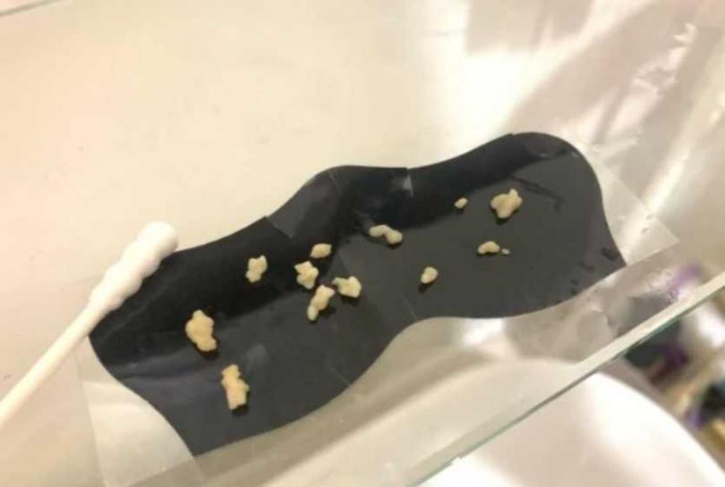 一名女網友從扁桃腺挖出大量的「白色小石頭」。(翻攝自Dcard)