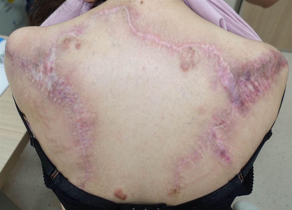 陳小姐背部嚴重蟹足腫經手術及放射治療後大幅改善。（基隆長庚醫院提供）