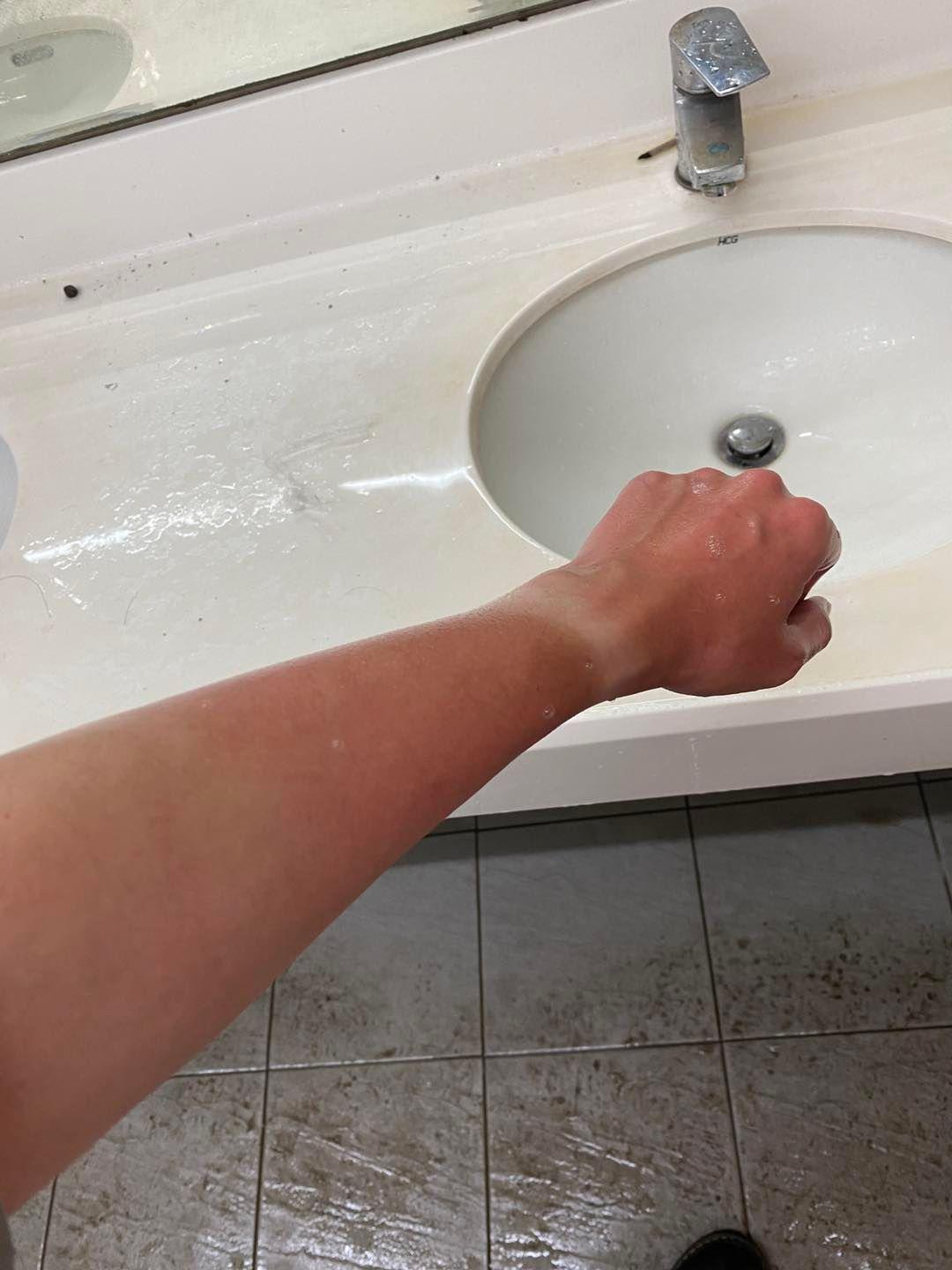 曾玟學手臂被胡椒噴霧噴到後，整個手臂感到灼燒刺痛紅腫。（翻攝自曾玟學臉書）