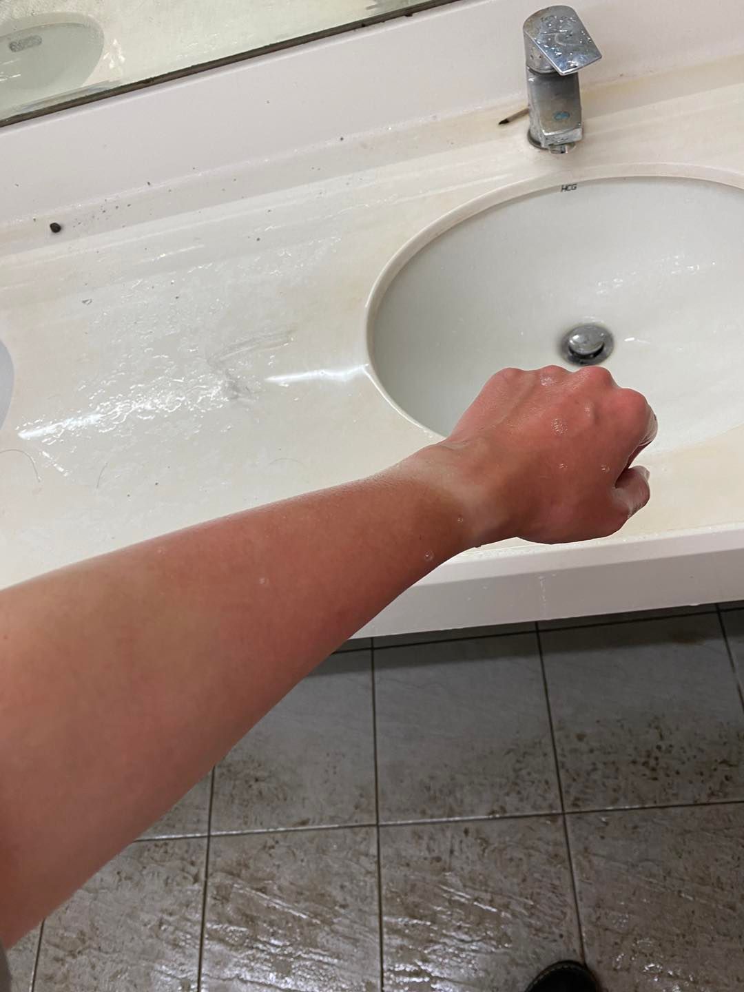 曾玟學手臂被胡椒噴霧噴到後，整個手臂感到灼燒刺痛紅腫。（翻攝自曾玟學臉書）