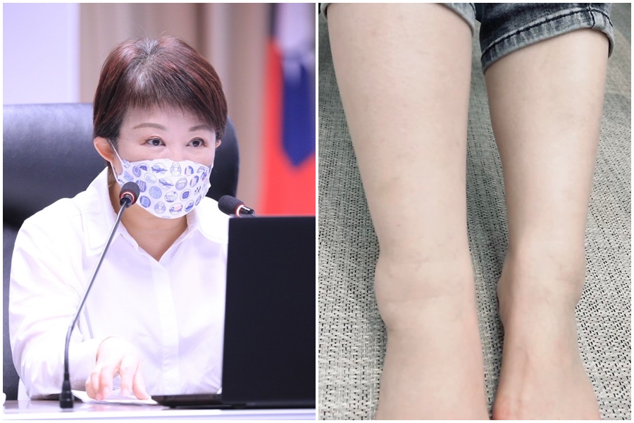 台中市長盧秀燕腿傷復發，今天臨時取消行程赴醫院治療。（翻攝自盧秀燕臉書）