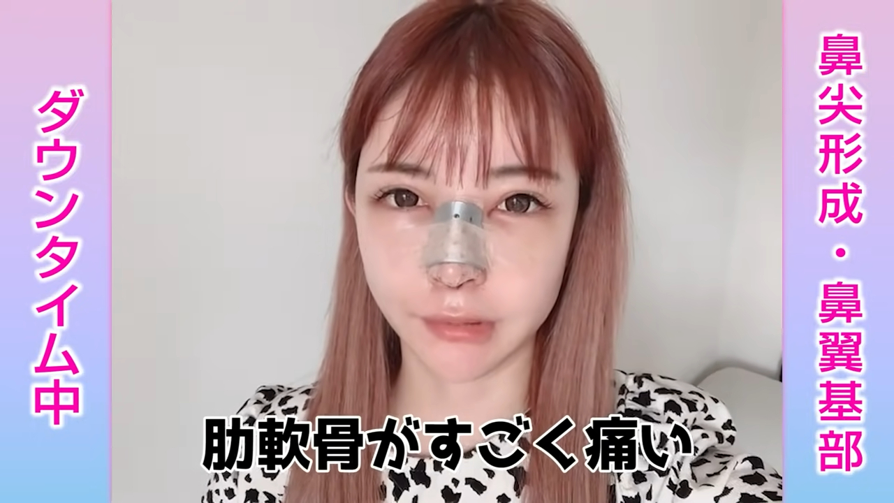 知惠曾公開自己4次整鼻手術的過程。(翻攝畫面)