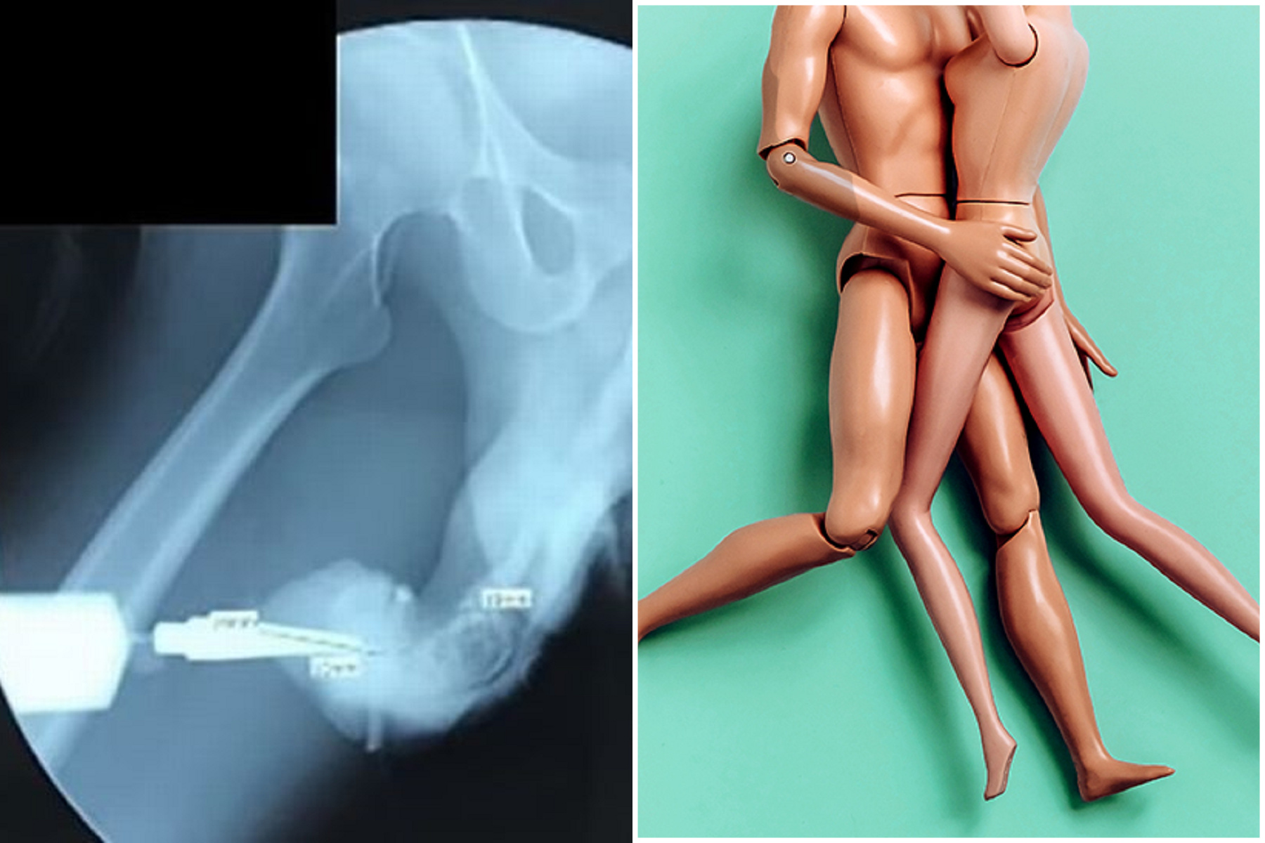 他脫褲「加油幹」悲劇了!做愛爽嗨卻斷莖爆血,「茄子彎彎」回不去。(翻自《每日星報》)