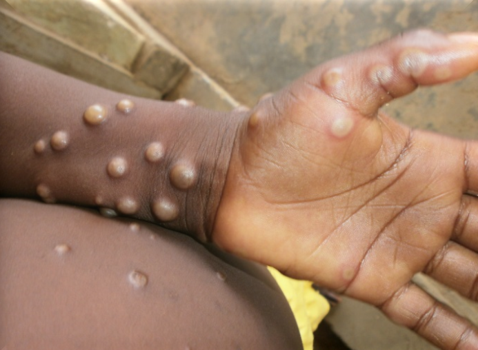 猴痘確診個案蔓延全球，世界衛生組織（WHO）日前已將猴痘列為「國際關注公共衛生緊急事件」。（翻攝自WHO官網）