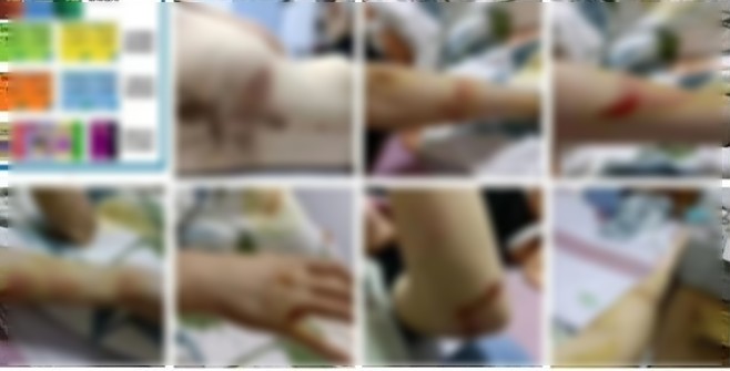 女走夜路遭性侵,曝光全身傷勢太驚人!凶手人高馬大竟才12歲。(翻自微博)