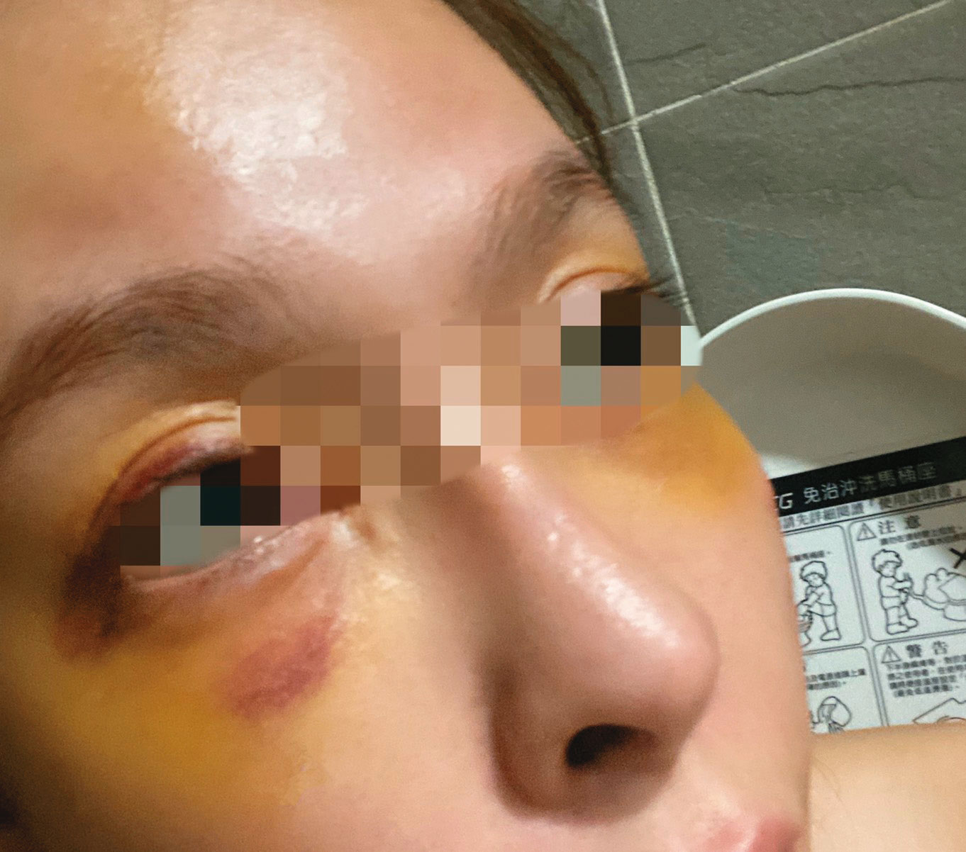 娃娃7月遭前男友施暴，當時她雙眼瘀青腫脹。（娃娃提供）