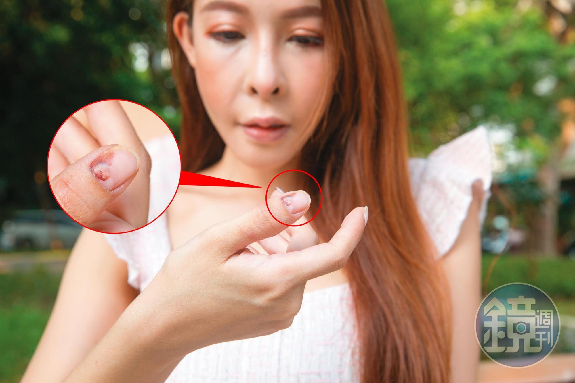 遭打近1個月,娃娃手指甲內瘀青仍清晰可見。