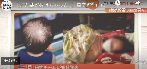 日本一名3歲男童確診康復後,出現嚴重脫髮。(翻攝自Youtube)