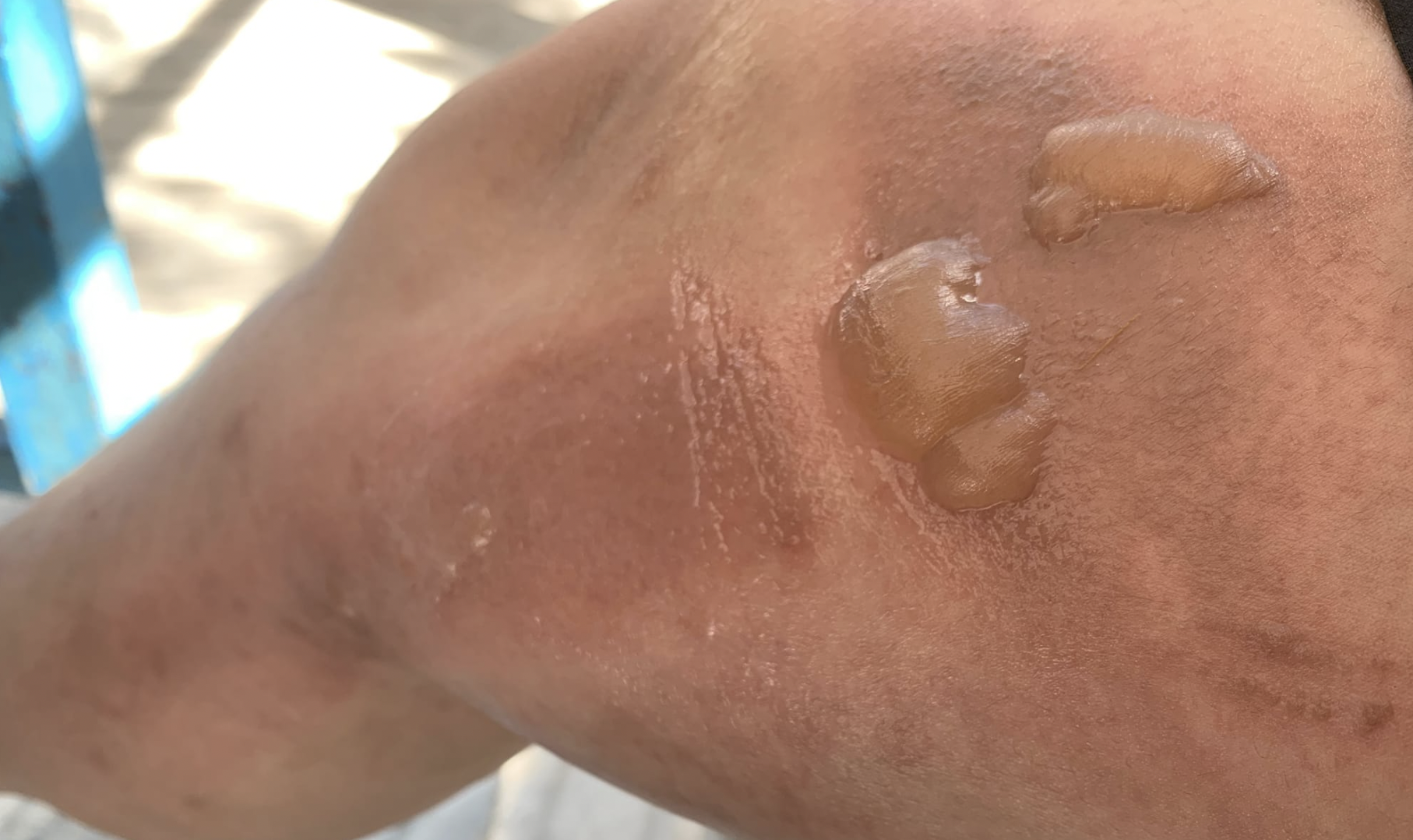 一名女網友在太魯閣的超商買泡麵，孰料下秒就被猴子整碗搶走，熱湯潑的她滿腿都是。（翻攝爆怨公社）