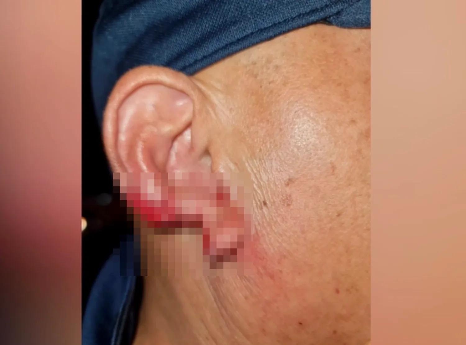 男子的右耳被坎姆頓咬掉一塊肉。(翻自《Sanook》)