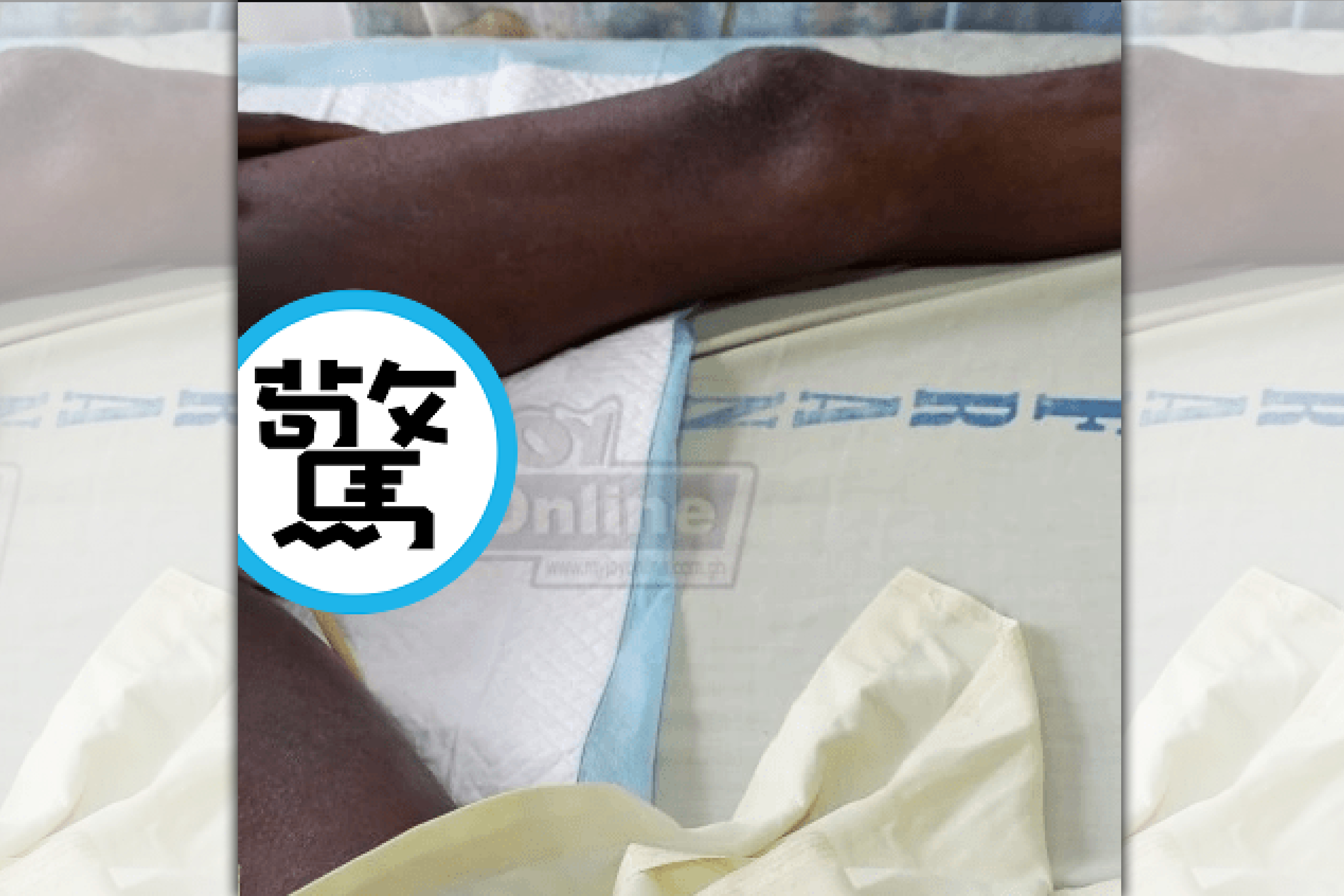 迦納一名男子作夢時拿刀切了自己的「G蛋」。（圖片來源: newstimes.com.ng）