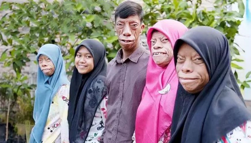 尼蘇門答臘島一家人罹患罕見疾病「崔契爾柯林斯症候群」，只有最小的女兒外表正常。（翻攝BornDifferentShow IG）