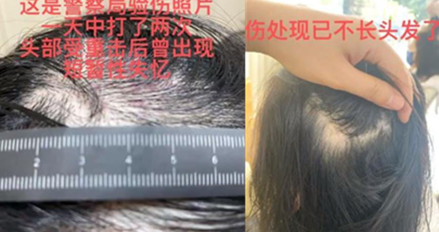 王東的老婆Annepple透露從警局回家後,王東對她進行更嚴重的毆打,把她打暈在地、昏迷不醒。(翻攝Annepple微博)