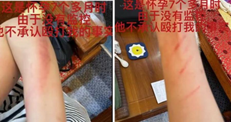 王東老婆公開自己懷孕7個月時被打的照片。(翻攝Annepple微博)