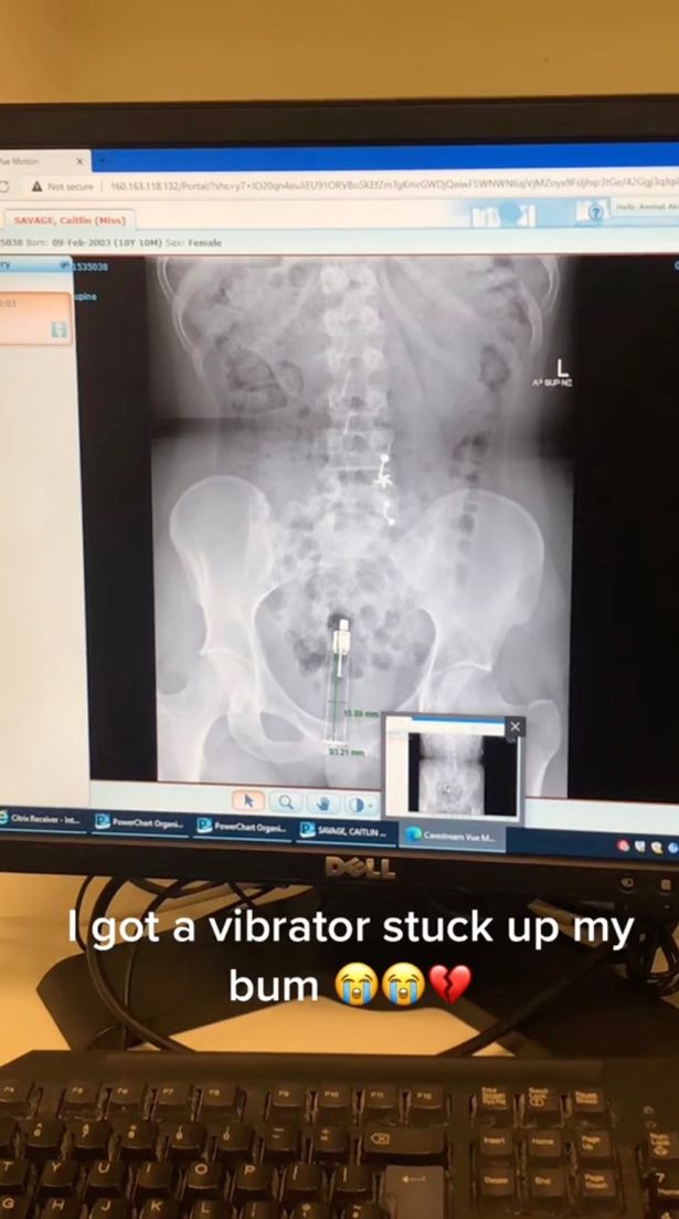 X光明顯可見，一個性玩具卡在薩薇吉的體腔內。（翻自TikTok）