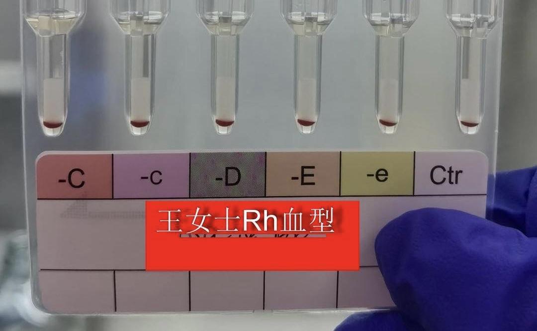 中國一名女子50歲才檢查出自己是超罕見的「黃金血」RhNULL血型。(翻攝自新京報)