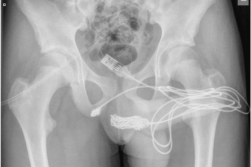 想測下體有多深？USB傳輸線「一插進洞」，打結拔不出超悲劇。（翻自《每日星報》）