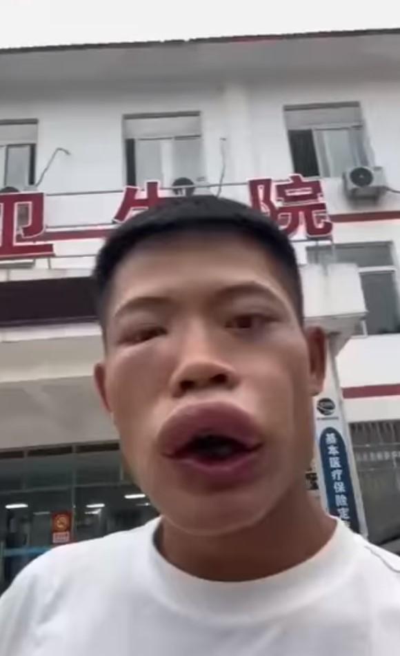 原本眉清目秀的王燦臉部腫到變形。(翻攝自抖音)