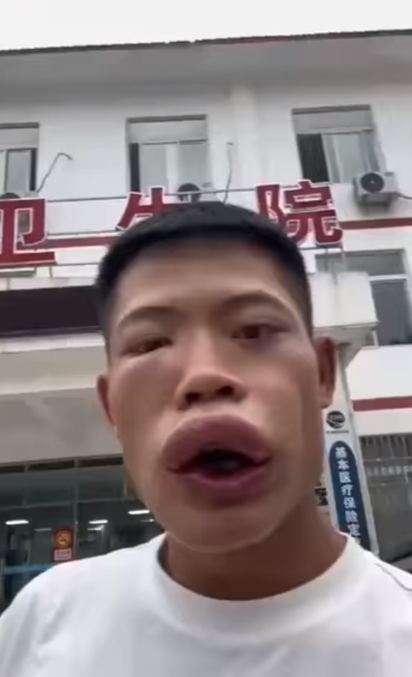 原本眉清目秀的王燦臉部腫到變形。（翻攝自抖音）