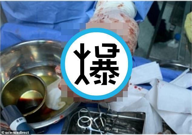 「吸塵器球」塞下體兩天,醫生徒手取物失敗!請出「電鑽插入肛」成就解鎖。(翻自《每日郵報》)