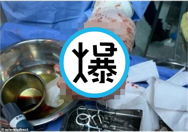 「吸塵器球」塞下體兩天，醫生徒手取物失敗！請出「電鑽插入肛」成就解鎖。（翻自《每日郵報》）