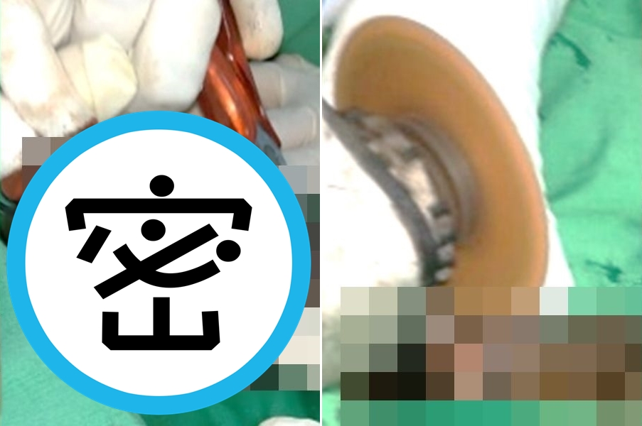 38歲男子為了持久套上「金屬陰莖環」卻無法順利取下，緊勒長達10小時，痛得找醫生救命根子。（翻攝ScienceDirect）