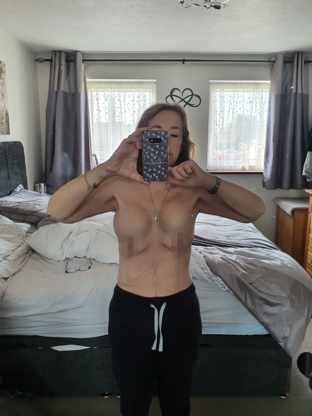 英國一名婦人在土耳其浴到黑心診所，害她一度有4個胸部。（翻攝自《太陽報》）