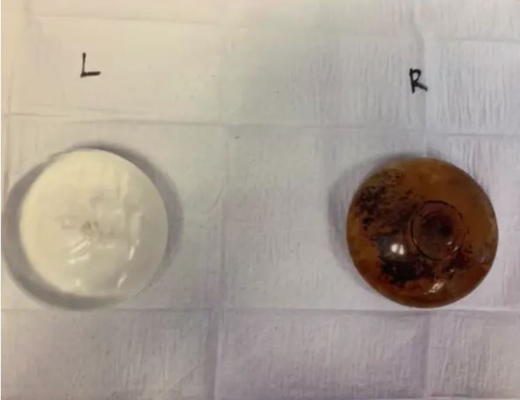 梅麗莎胸口裡的鹽水袋發霉腐爛，讓醫生驚呆了。（翻攝IG melisssssalima）