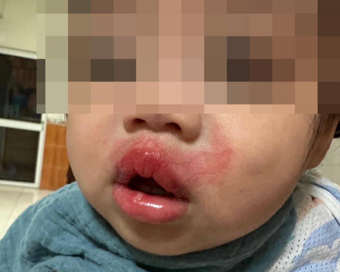 高雄一歲女童疑遭保母燙成香腸嘴。（翻攝自爆料公社）