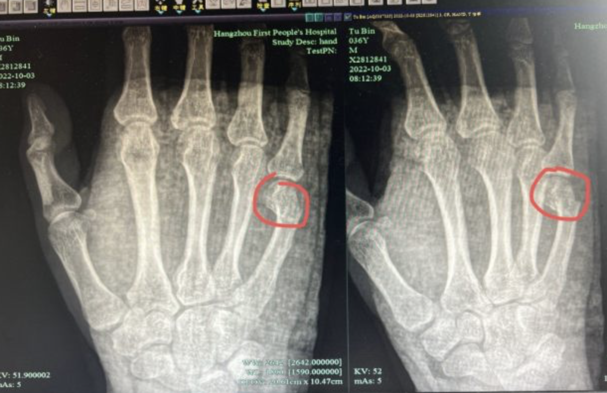 一名父親因教孩子功課半個多小時還教不會,氣到用手槌桌子,沒想到槌到自己手掌骨折。(翻攝杭州網)