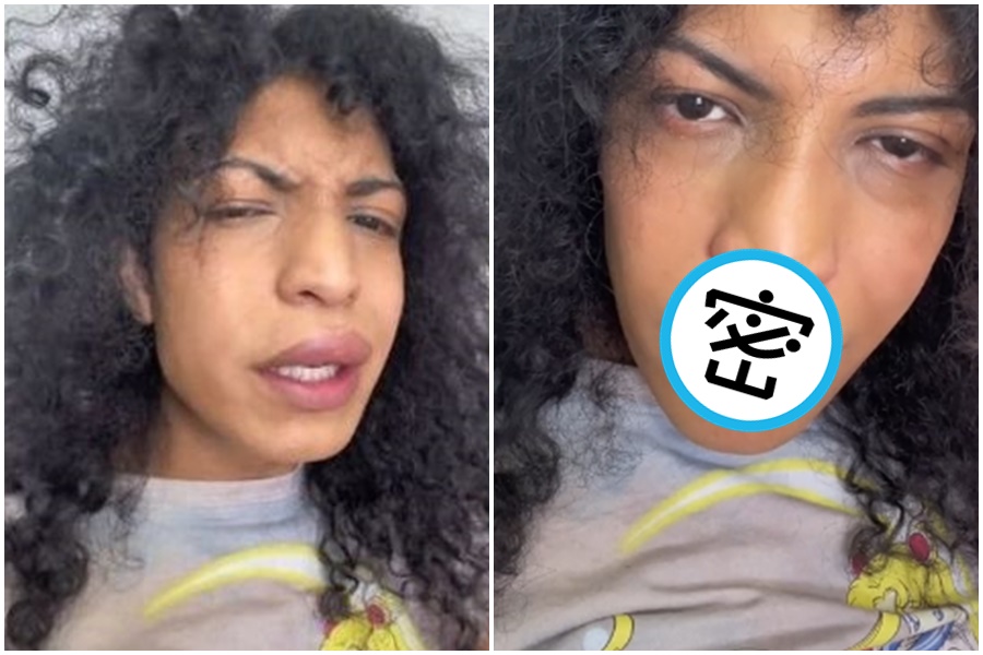 美國一名女子近日與男友約會接吻後,沒想到隔天嘴唇嚴重紅腫,差點因為與對方熱吻喪命。(翻攝自抖音)