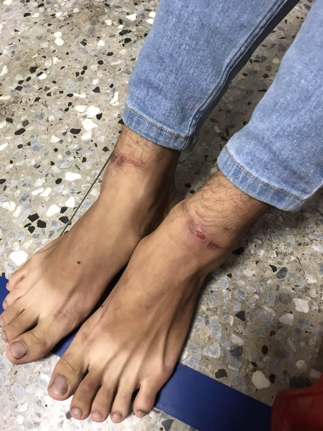 被害人的腳傷痕累累。(警方提供)