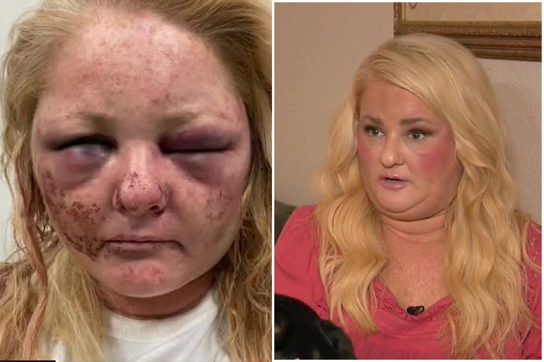 她慘遭暴力性侵毀全臉，咬爆凶嫌生殖器反擊！勇敢曝光受訪。（翻自《每日星報》）