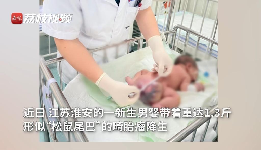 中國江蘇一名男嬰出生時臀部就長了一條類似「松鼠尾巴」的畸胎瘤。（翻攝荔枝新聞）