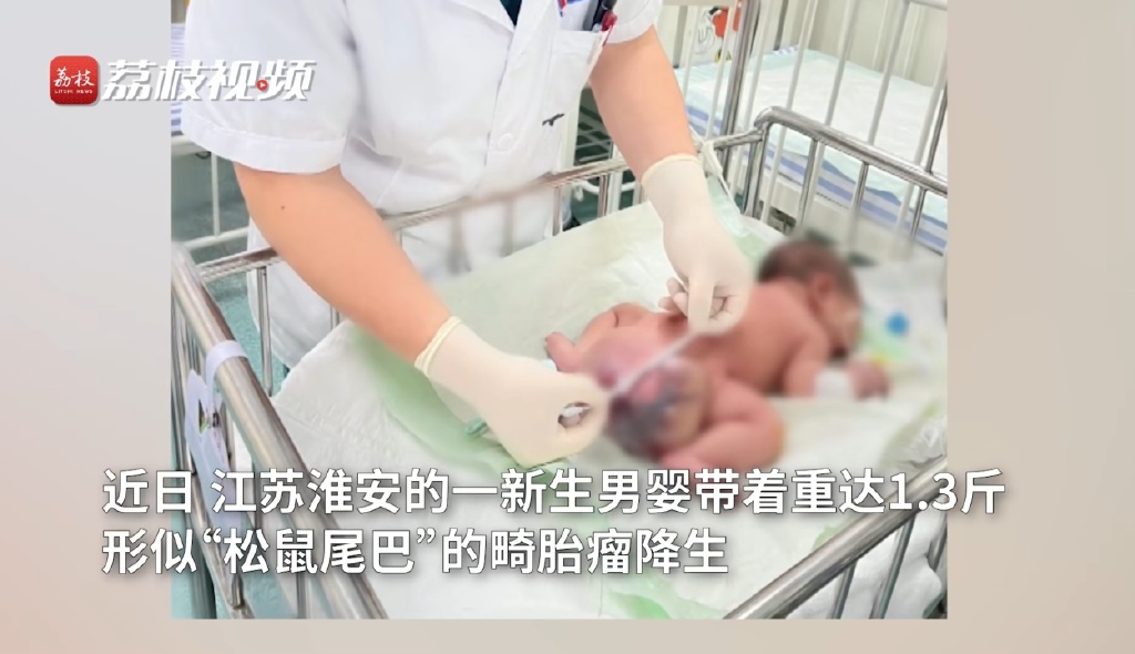 中國江蘇一名男嬰出生時臀部就長了一條類似「松鼠尾巴」的畸胎瘤。（翻攝荔枝新聞）