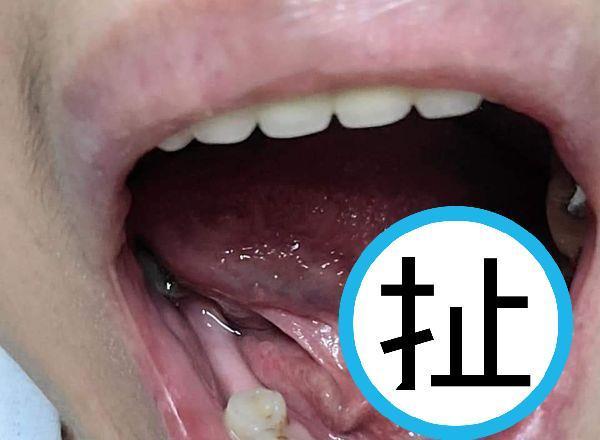 一名網友去牙醫診所拔牙，結束後卻發現舌頭下面被鑽了一個大洞，喝水都會痛到哭。（翻攝爆料公社）