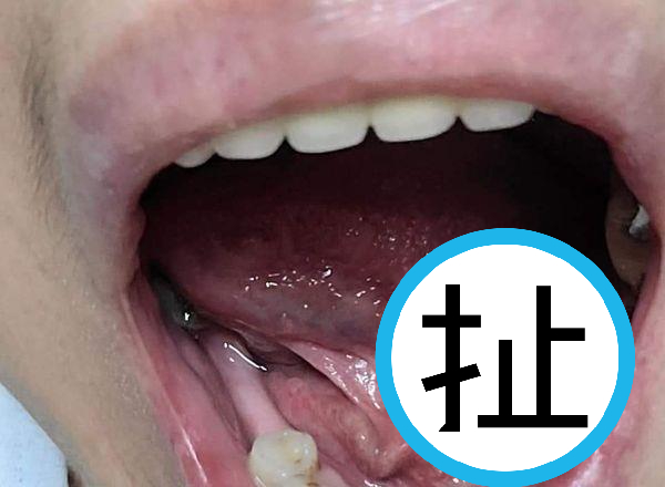 一名網友去牙醫診所拔牙，結束後卻發現舌頭下面被鑽了一個大洞，喝水都會痛到哭。（翻攝爆料公社）
